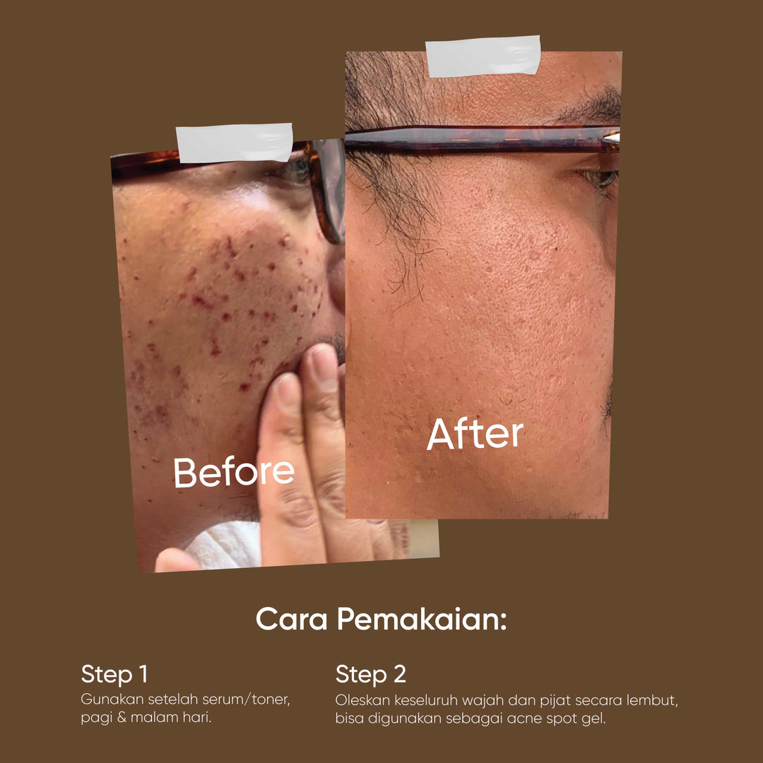 Votre Peau x Biograft Combo Pimple Punch Pack