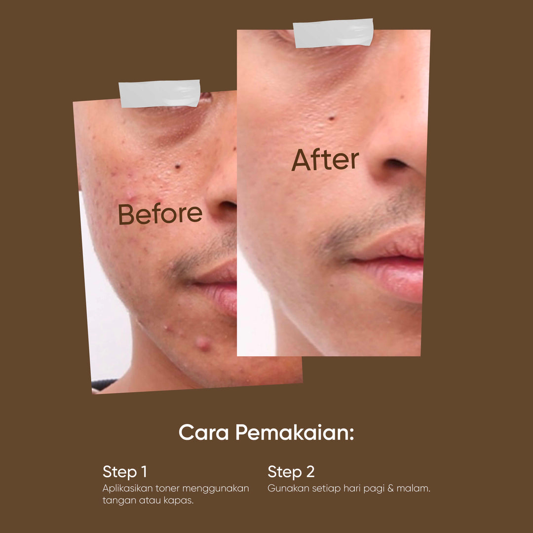 Votre Peau Salycilic Acid Acne Toner 100ml - Toner Wajah Berjerawat