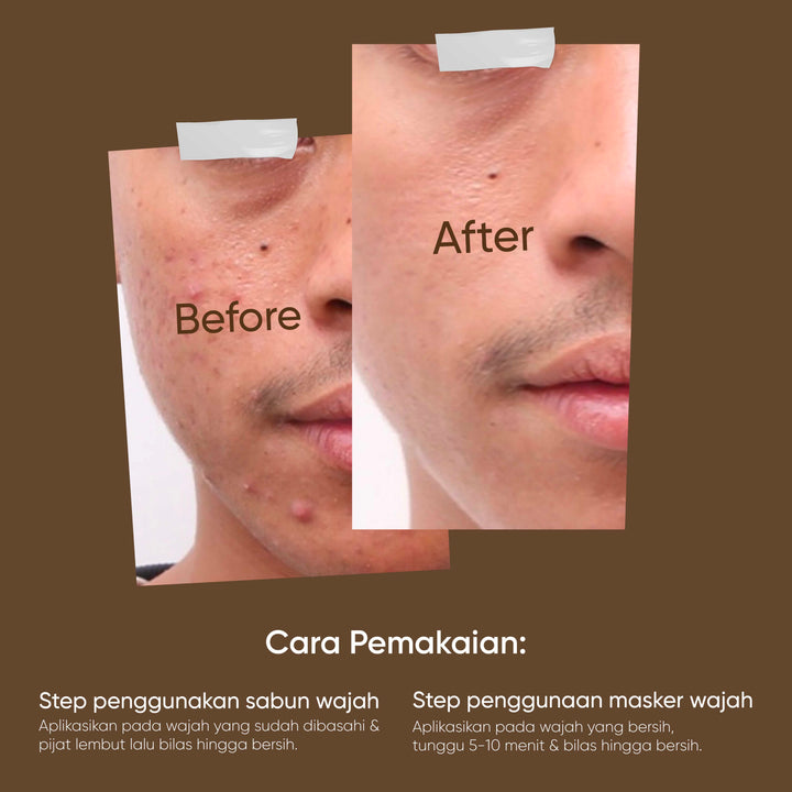 Votre Peau Salycilic Acid Acne Facial Wash 100ml - Sabun Wajah Berjerawat